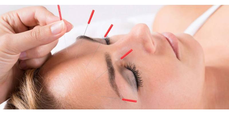 Kozmetik Akupunktur